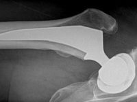 The Long Road to Finding Out What’s Wrong With My&nbsp;Hip
